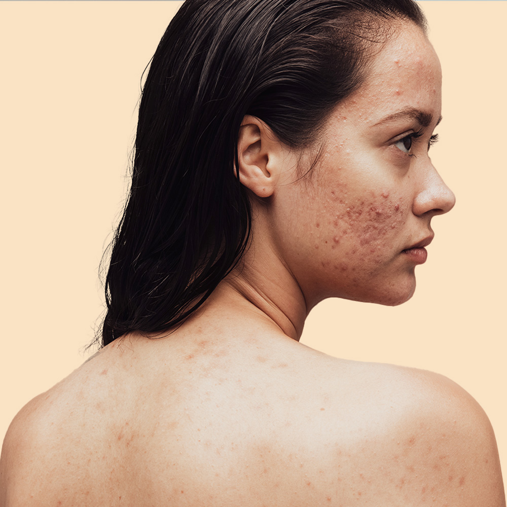 Woman with acne profile view.