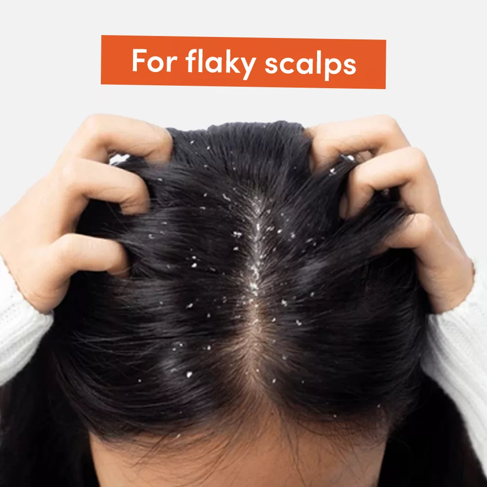 Hands on flaky scalp