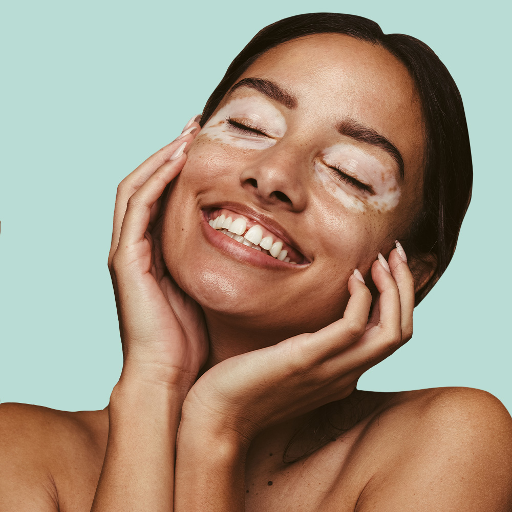 Smiling person with closed eyes and vitiligo.